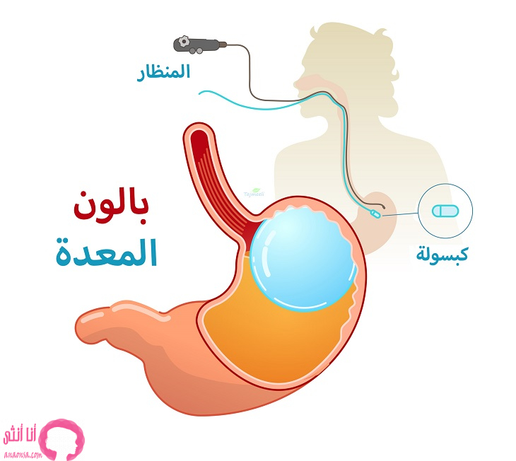 جراحة بالون المعدة في تركيا