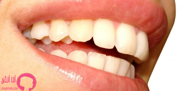 مشاكل الأسنان الشائعة