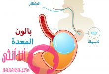 جراحة بالون المعدة في تركيا