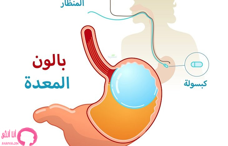 جراحة بالون المعدة في تركيا