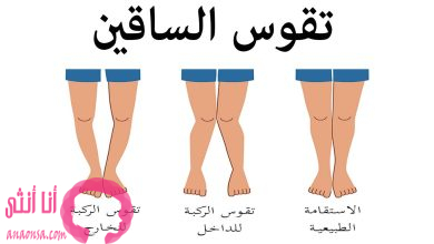 الكشف عن تقوس الساقين